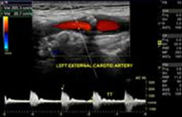 Carotid Artery Ultrasound 3