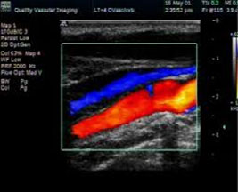 Vascular Doppler | My Concierge MD in Beverly Hills
