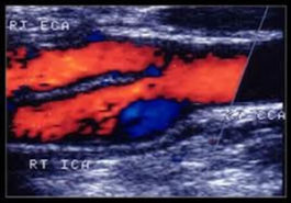 carotid-ultrasound-5