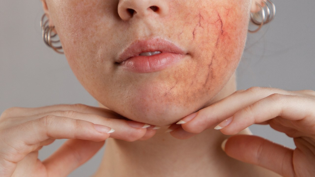 Can peptides help with skin conditions like eczema or rosacea