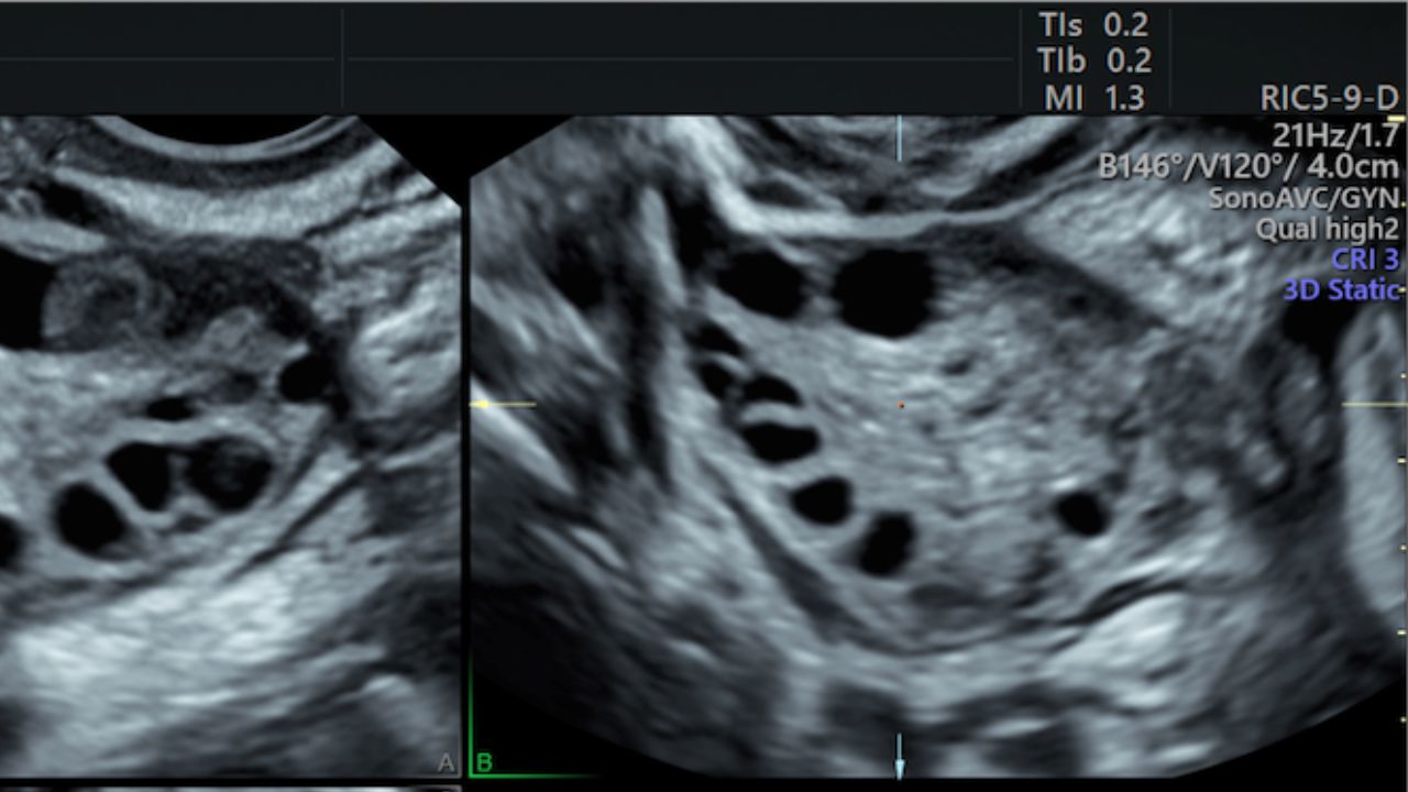 How does PCOS look on an ultrasound - MY CONCIERGE MD