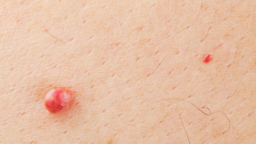 Does Soap Kill Wart Virus? MyConciergeMD