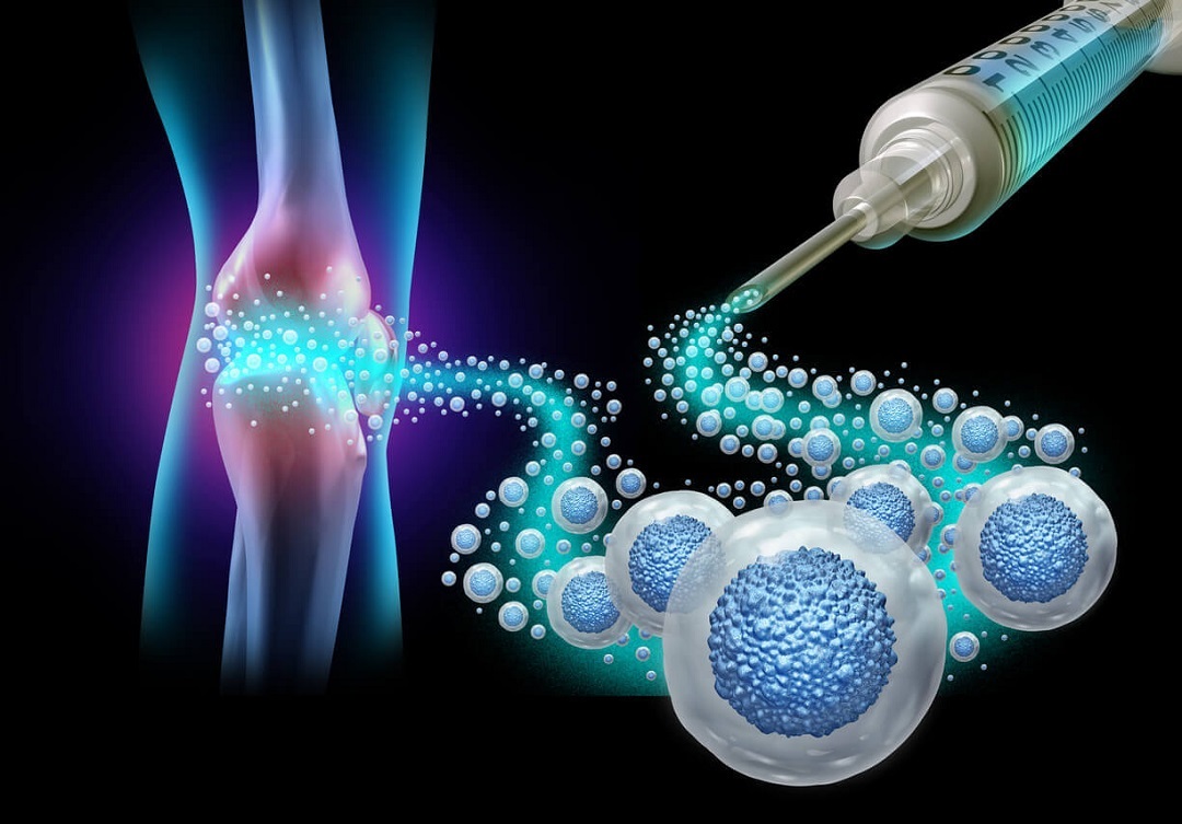 Stem Cell Injections: A Future of Healing