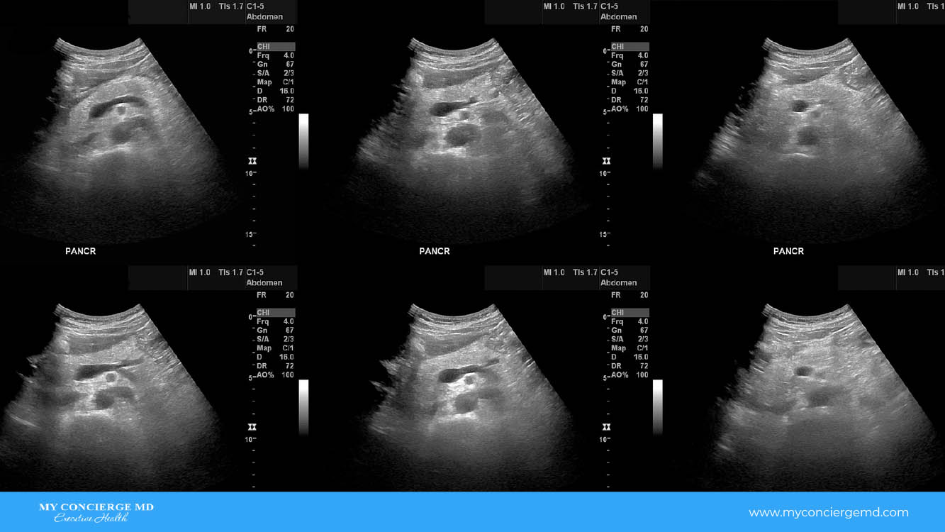 Echogenic Pancreas Ultrasound